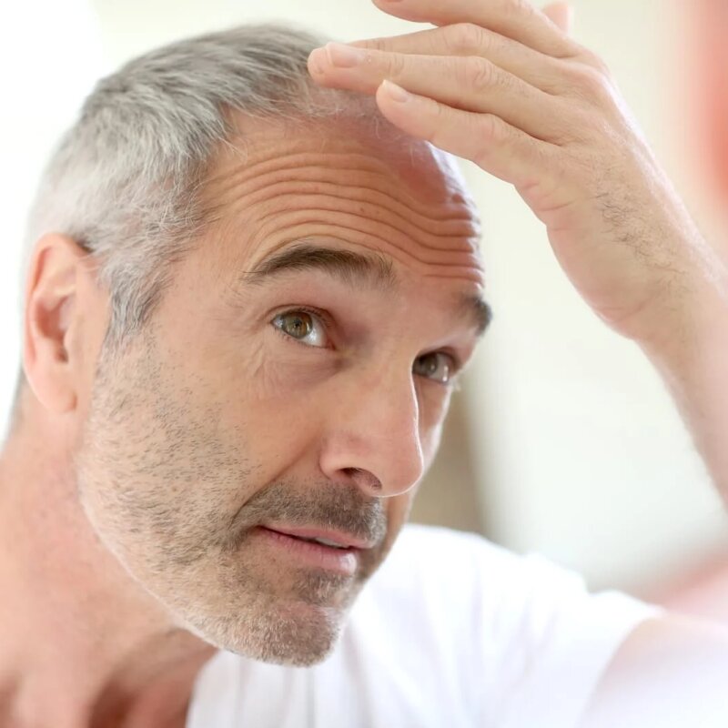Hair Loss